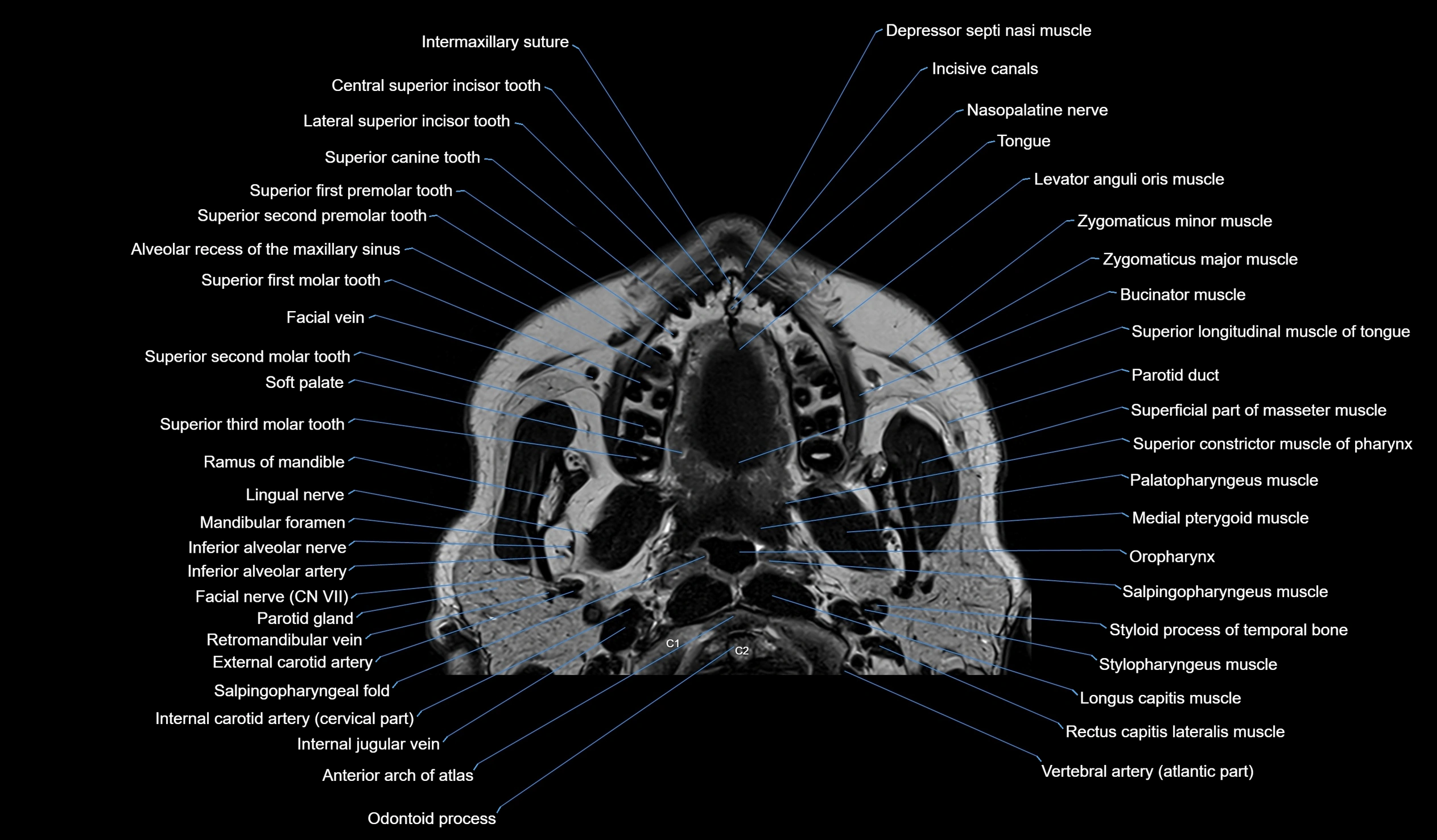 MRI face & paranasal sinuses(PNS) labelled  coronal  cross sectional anatomy 3T radiology  image-img-00001-00003.webp